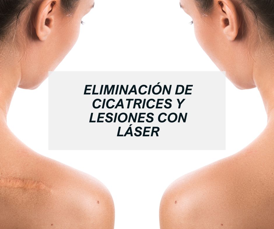 Blog eliminación cicatrices con láser