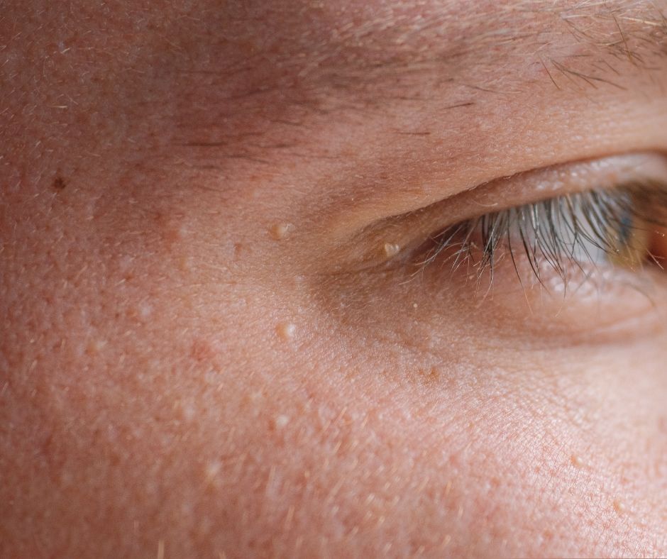 eliminación cicatrices con láser